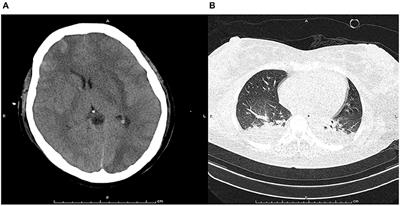 Atypical Posterior Reversible Encephalopathy Syndrome in a Postpartum Woman With Moyamoya Disease: A Case Report and Literature Review